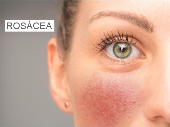 Rosácea: causas, síntomas y tratamiento